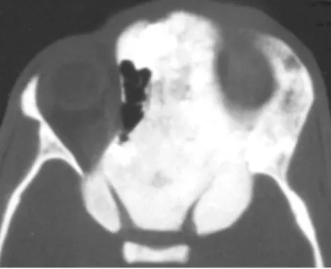 Figura 1. Displasia fibrosa monostótica. (a) Corte axial TC en ventana ósea a nivel orbitario que demuestra pro-