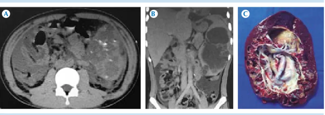 Figura 11.  Hombre de 16 años con hallazgo incidental de lesión esplénica, multifocal hipodensa, con calcifica- calcifica-ciones intralesionales, múltiples