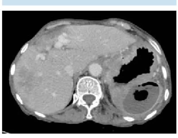 Figura 6.  Mujer de 69 años con cáncer gástrico en el  que se demuestra complicación del proceso  neoplá-sico primario con metástasis infectada condicionando  absceso  esplénico,  selección  de  imagen  axial  de  tomografía poscontraste.