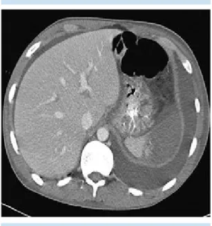 Figura 7.  Imagen axial de tomografía con contraste in- in-travenoso en mujer de 21 años, con lupus eritematoso  sistémico, tromboembolia pulmonar, derrame pleural  izquierdo e infarto esplénico.