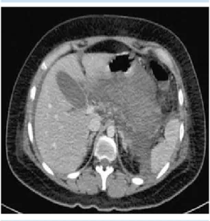 Figura 9.  Mujer de 32 años con diagnóstico clínico  de pancreatitis aguda leve de origen biliar; estudio  de tomografía contrastado, selección de imagen axial  donde se demuestra el líquido libre intraabdominal;  con reforzamiento de la glándula pancreáti