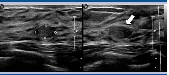 Figura 2. Nódulo (flecha) categoría BIRADS 3 en paciente de 40 años con patrón glandular denso.