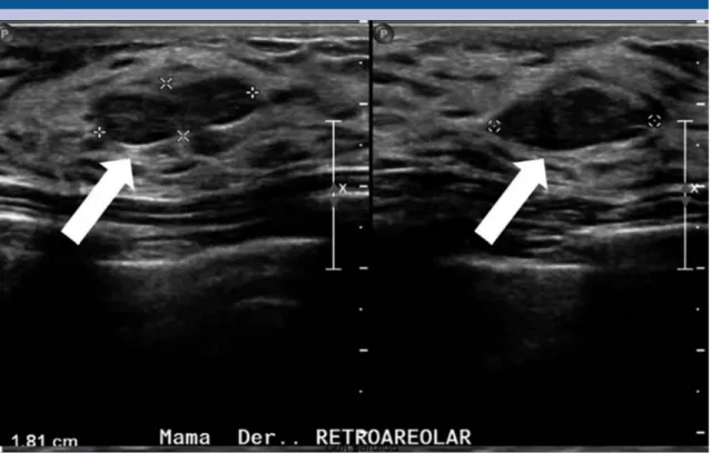 Figura 3. Nódulo de 1.8 cm (flecha), categoría BIRADS 3, sin representación mamográfica ni en tomosíntesis,  en un patrón glandular denso.