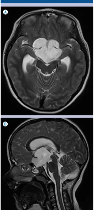 Figura 1.  Paciente de 6 años con diagnóstico de as- as-trocitoma pilocítico.  A-B)  Resonancia magnética T2  axial y coronal: lesión cuyo componente principal se  localiza en la cisterna supraselar y condiciona  dilata-ción del sistema ventricular suprate