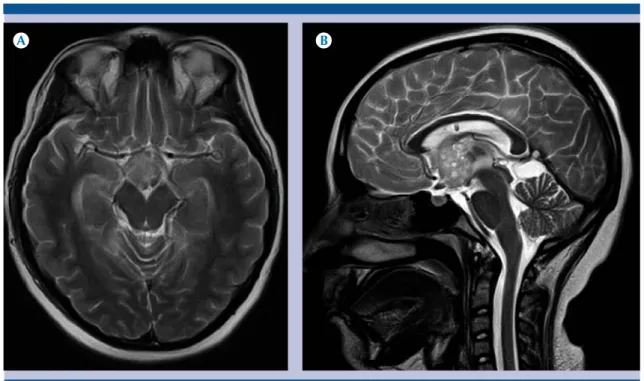 Figura 3.  Paciente de 13 años con diagnóstico de astrocitoma anaplásico.  A-B)  Resonancia magnética T2 axial  y coronal: lesión de componente mixto (sólido-quístico) localizada en la cisterna supraselar.