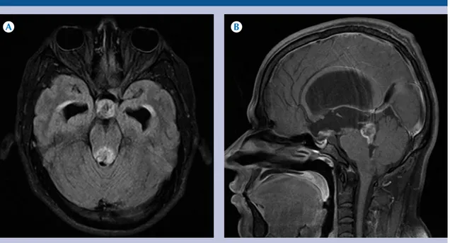 Figura 4.  Paciente de 26 años con diagnóstico de astrocitoma pilocítico.  A-B)  Resonancia magnética FLAIR axial  y T1 + C sagital: dos lesiones localizadas en la cisterna cuadrigémina y en la cisterna supraselar que muestran  realce heterogéneo con el me