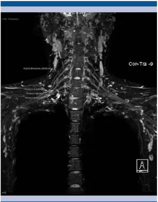 Figura 1.  Reconstrucción de resonancia magnética  en 3D: salida de los nervios que constituyen el plexo  braquial, así como la formación en los troncos  supe-rior, medio e inferior.