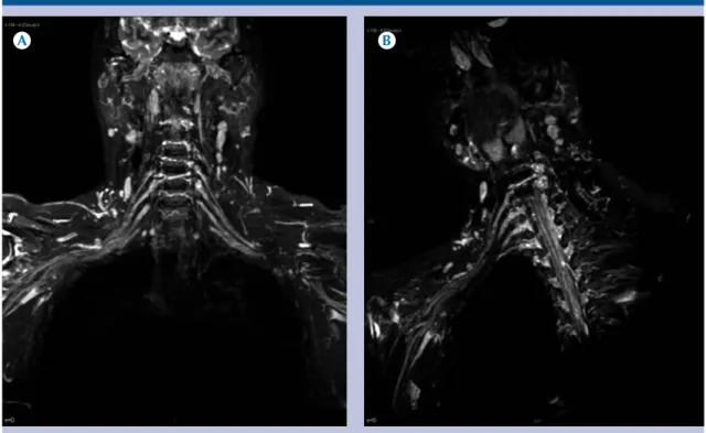 Figura 4. A)  Reconstrucción 3D de resonancia magnética de plexo braquial: compresión del tronco superior  derecho por el músculo escaleno medio