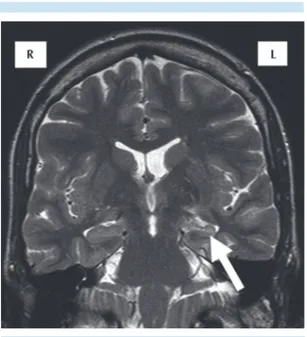 Figura 1.  Resonancia magnética secuencia coronal T2:  hiperintensidad y atrofia del hipocampo izquierdo en  un paciente con epilepsia del lóbulo temporal (flecha).