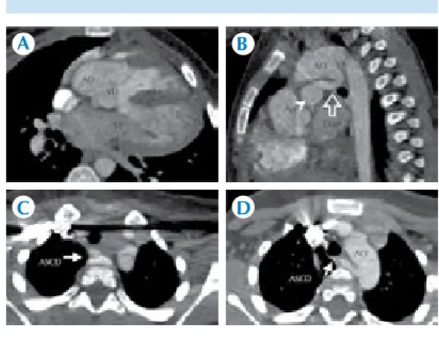 Figura 13. A-B)  Arteria coronaria única. Paciente con  diagnóstico de tetralogía de Fallot
