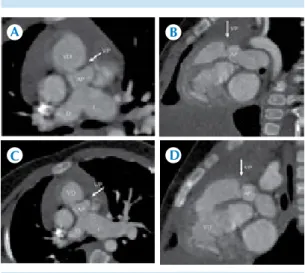 Figura 4. Hipertrofia ventricular derecha. Se demuestra  hipertrofia ventricular de la pared muscular del  ventrí-culo derecho con incremento de la relación ventríventrí-culo  derecho/ventrículo izquierdo