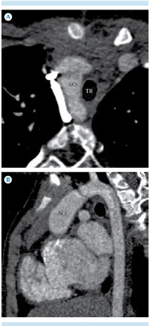 Figura 12. A-B)  Estenosis pulmonar severa. Paciente  con diagnóstico de tetralogía de Fallot con estenosis  pulmonar severa (círculos).
