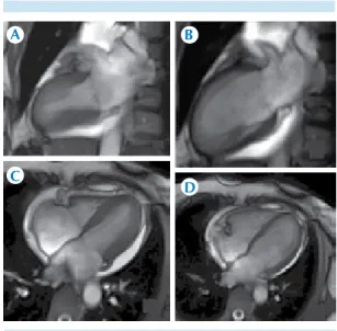 Figura 8. Diferencia entre las densidades en unidades  Hounsfield de los segmentos basales y  mediales  en  comparación  con  los  segmentos  apicales;  modelo  de 17 segmentos de la American Heart Association.