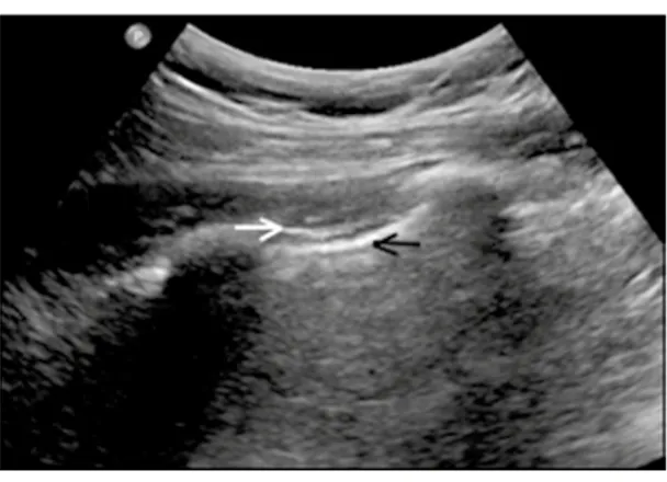 Figura 2.  Deslizamiento de la pleura parietal (flecha  blanca)  sobre  la  visceral  (flecha  negra)  (en  inglés  “lung sliding”).