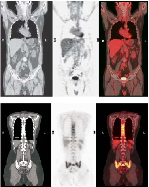 Figura 6. Estudio PET/CT normal.