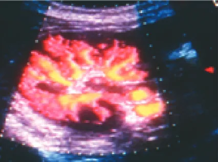 Figura No. 4. Power Doppler donde se observa la vasculatura completa del riñón