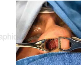Figura 3: Fotografía clínica. Fosa nasal derecha con tumoración de color 