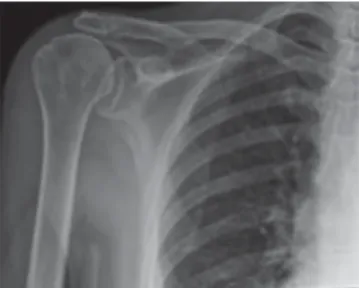 Figura 1. Radiografía anteroposterior prequirúrgica de hombro derecho. 