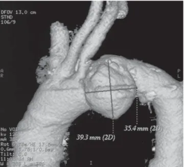 Figura 2. Reconstrucción tridimensional de la tomografía axial que mues-