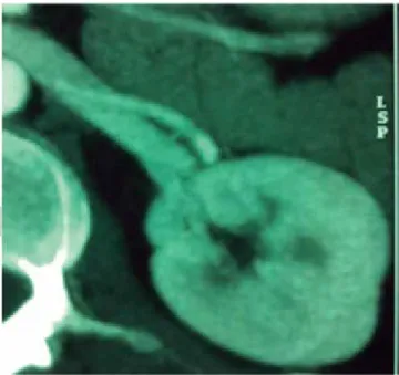 Figura 3. Corte axial por tomografía computada del riñón izquierdo a ni-