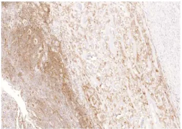 Figura 4. Inmunomarcación con CD10 positiva en el sarcoma del estro-