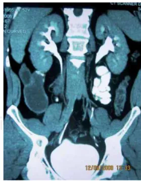Figura 1. Tomografía computada de abdomen, corte coronal. 