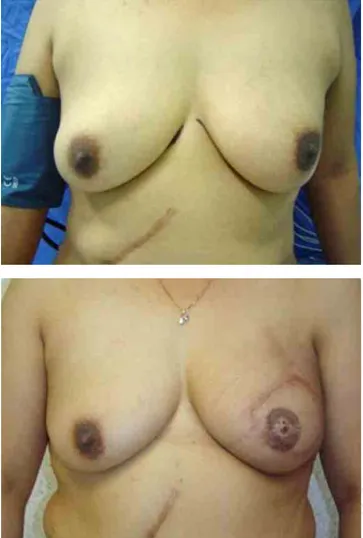 Figura 5. Pre y posoperatorio de reconstrucción mamaria inme- inme-diata izquierda.