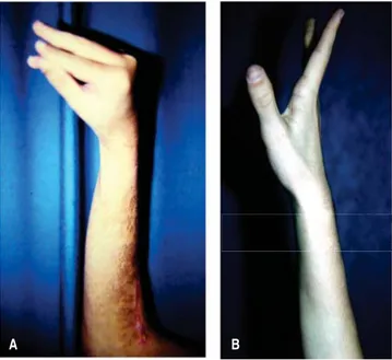Figura 5A. Parálisis baja; se aprecia extensión de la muñeca pero impo- impo-sibilidad de extensión de los dedos y abducción del pulgar, y 5B