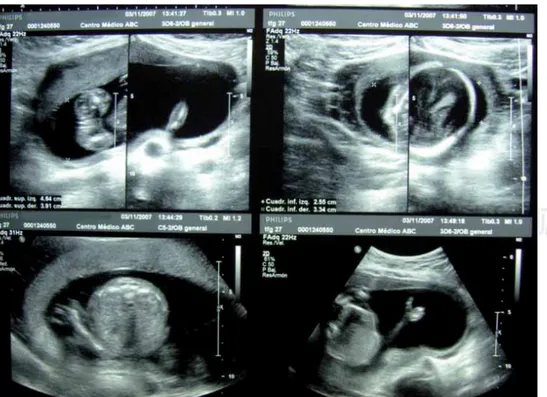 Figura 1. Ultrasonido prenatal. El cua-