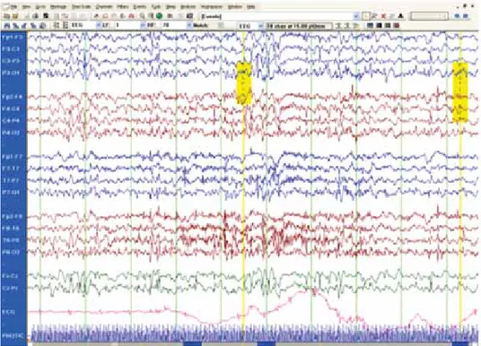 Figura 1. EEG durante la fotoestimula- fotoestimula-ción que muestra actividad epileptiforme  generalizada, asociada a crisis  mioclóni-cas inducidas por el estímulo fótico.