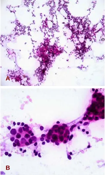 Figura 4. Impronta en transoperatorio de ganglio centinela. A: