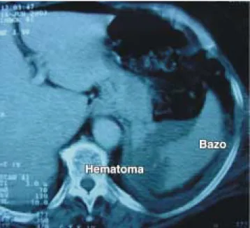 Figura 3. Tomografía de abdomen con lesión grado I esplénica.