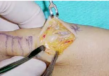 Figura 5. Fotografía quirúrgica de la exéresis del neuroma de la