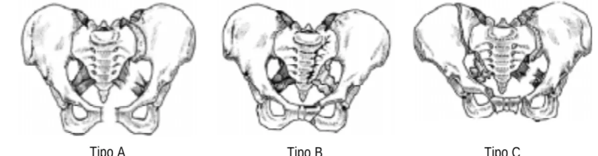 Cuadro I. Clasificación de Tile. Tipo A. Lesiones estables.