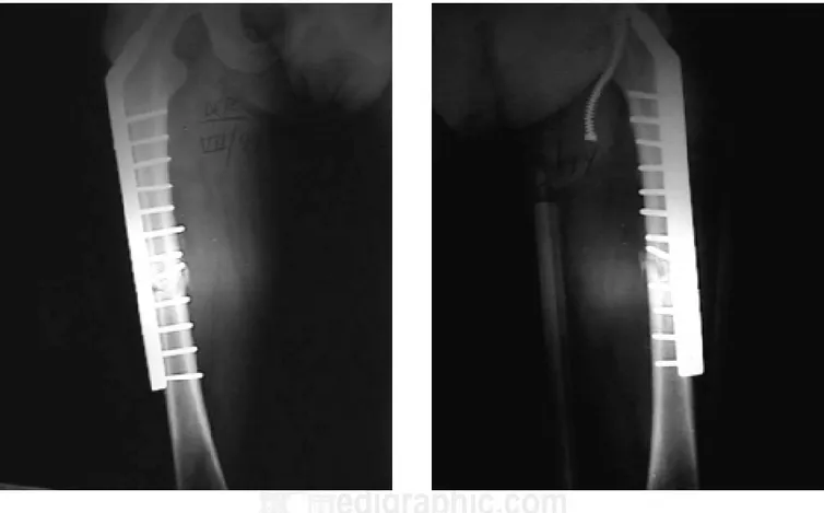 Figura 1. Radiografía anteroposterior de fémur derecho con cla-