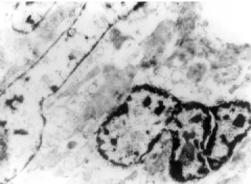 Figura 6. Leiomiosarcoma de sigmoides.