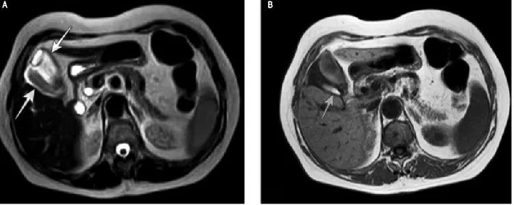 Figure 1. Figure 1. ERCP showing, (A) (A) (A) (A) the gallbladder (white arrow) and a second pear shaped cystic formation (black arrow) and (B) (A) (B) (B) (B) (B) a normal cystic duct (white arrow).