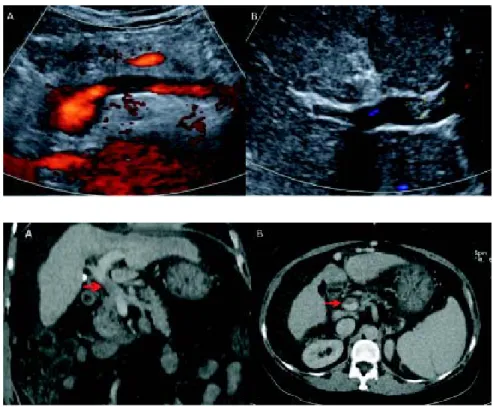 Figure 3. Computed tomography im- im-age of total thrombosis of the portal vein is seen in A with a coronal view  (ar-row)