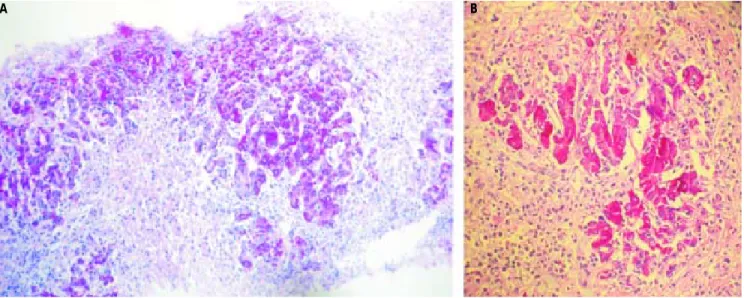 Figure 2. Anatomopathological liver specimen of case 1 (PAS stain). Massive hepatocellular necrosis