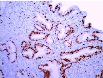 Figure 6. Intramucosal adenocarcinoma. A cribriform