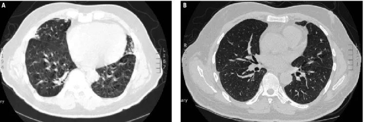 Figure 3. Case 2. A.  HRCT scan showing bronchial wall thickening and mosaic pattern of attenuation suggestive of bronchioli-