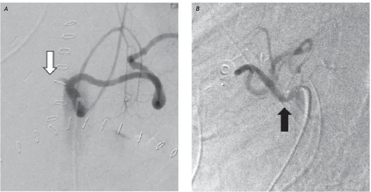 Figure 2. A. Digital substraction angiography in anteroposterior projection of the celiac artery showing lack of opacification
