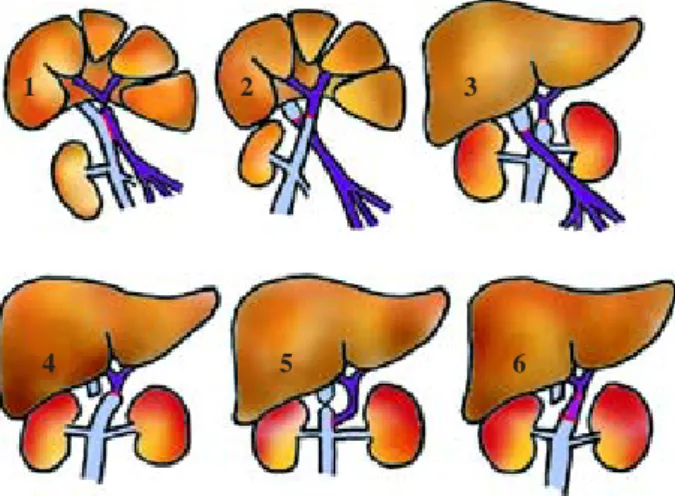 Figure 2. Evolution of cavoportal hemitransposition (vena cava
