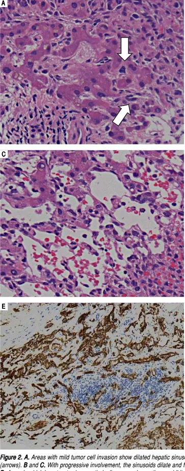 Figure 2. A. Areas with mild tumor cell invasion show dilated hepatic sinusoids lined by hypertrophied endothelial cells with atypical hyperchromatic nuclei (arrows)