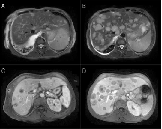 Figure 1. Conventional MRI images of liver metastases from small lung cell  carcino-ma