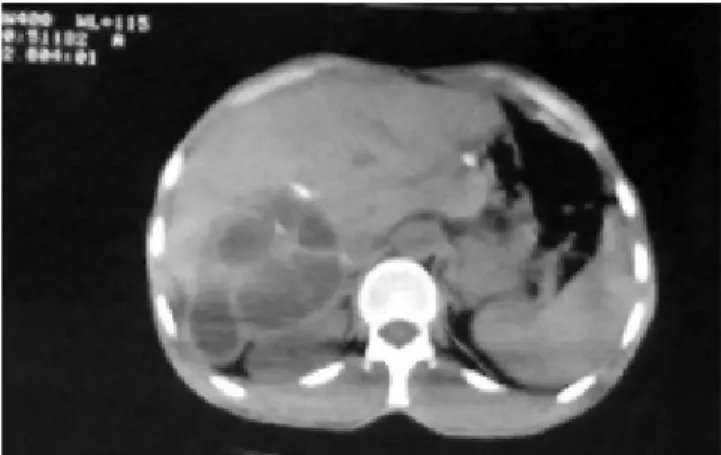 Figure 2. Computed tomography of a hydatid cyst with in-
