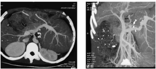 Figure 4. CT image of the recipient two months post operation. The graft has proliferated significantly
