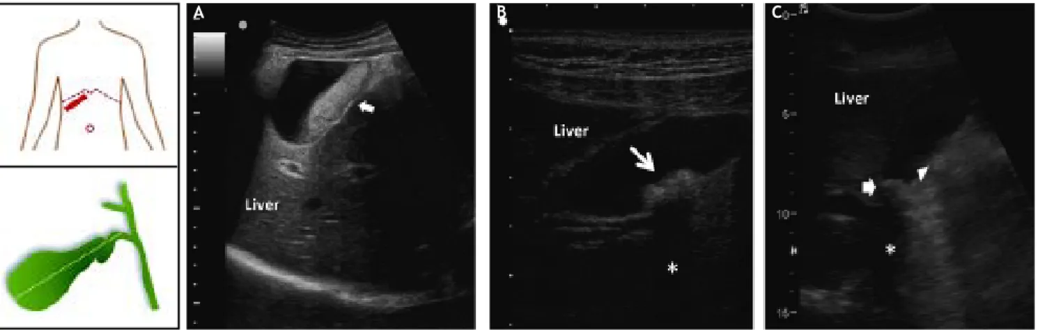 Figure 2. Ultrasonographic appearance of biliary sludge, gallstones, and gallstone plus biliary sludge in the gallbladder
