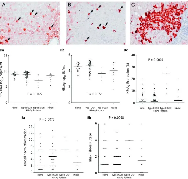 Figure 1. Staining patterns of HBsAg. A. Some moderate to strong homogeneously cytoplasm HBsAg stained hepatocytes