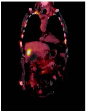 Figure 2. PET-CT with 18-FDG with osteolytic and osteo-